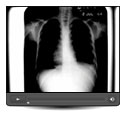 Watch - Tuberculosis Strikes Students at Holy Cross Separate School Video, 1964